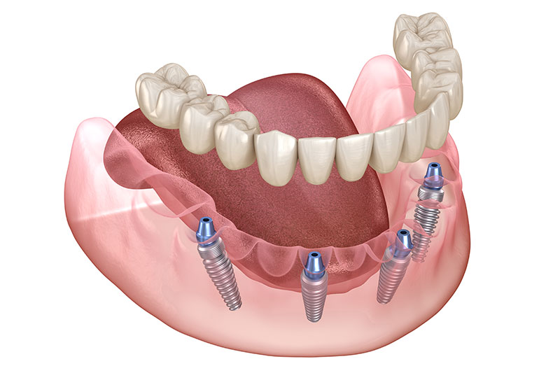 All on 4 Dental Implants in Rhome