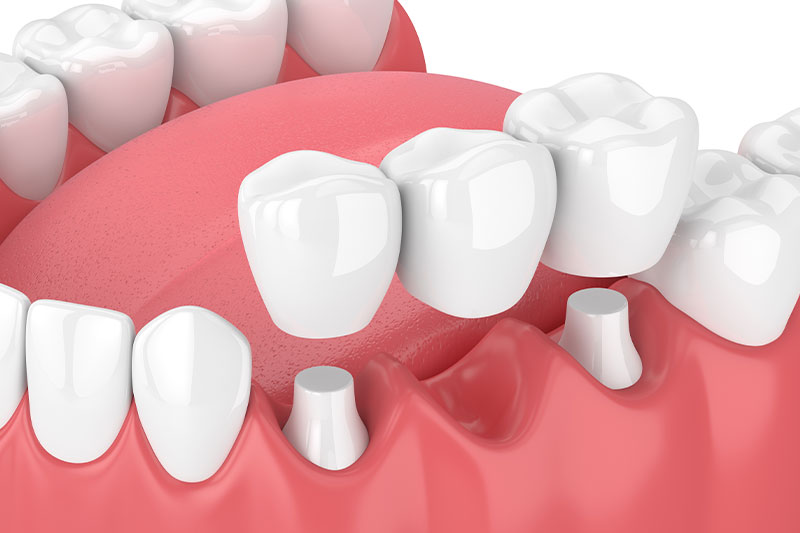 Dental Bridges in Rhome