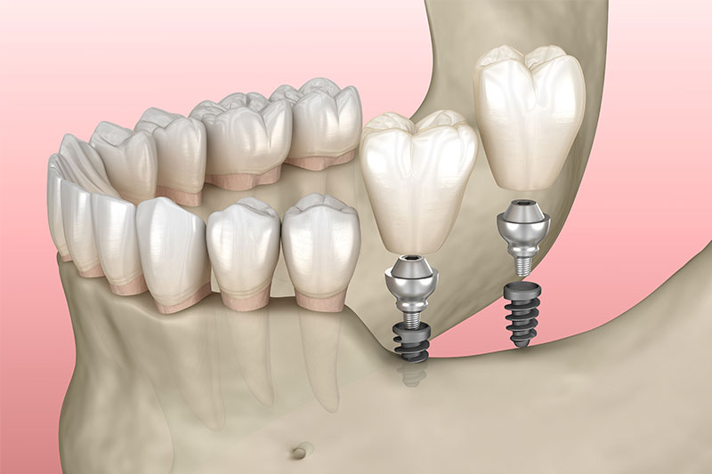 Multi-Tooth Implants in Rhome
