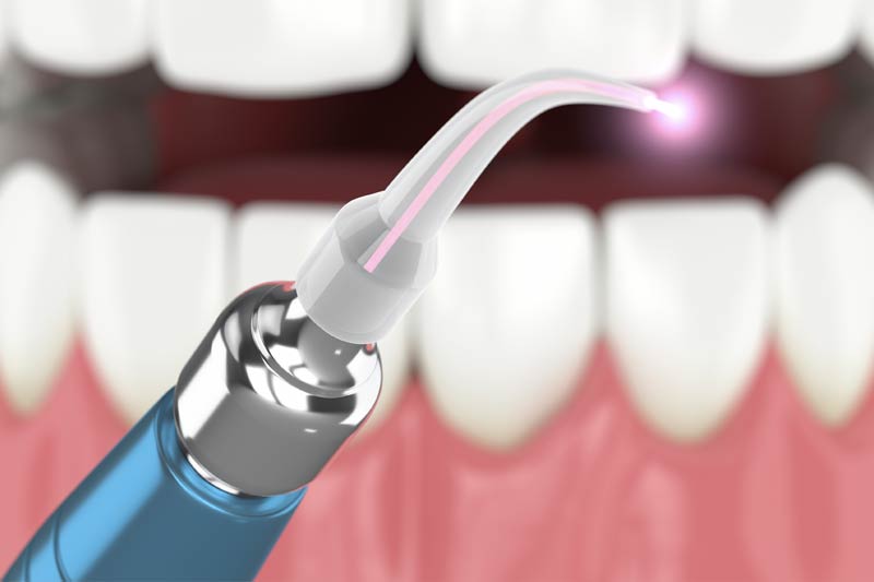 Gum Disease Laser Treatment in Rhome