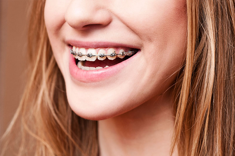 Orthodontics in Rhome