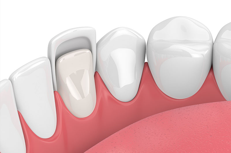 Porcelain Veneers in Rhome