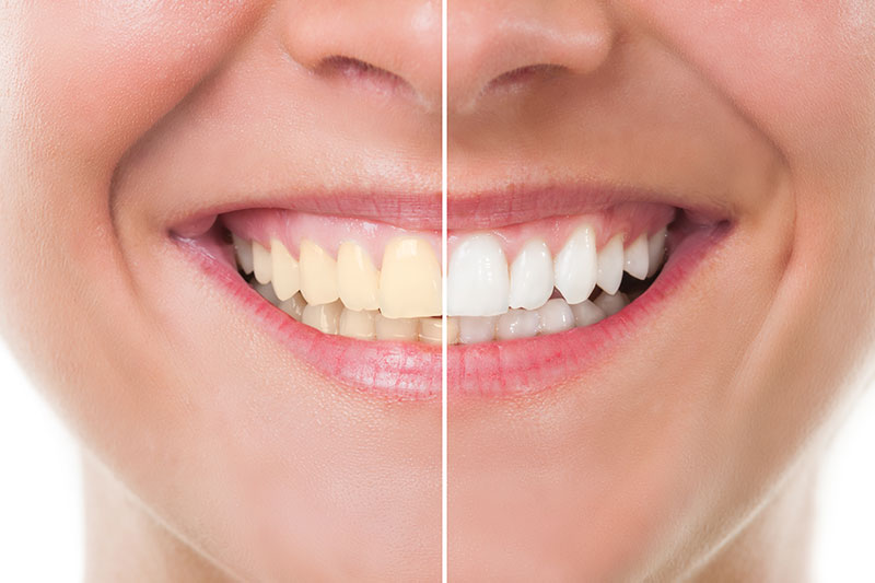 Teeth Whitening in Rhome