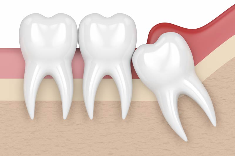 Wisdom Tooth Removal in Rhome